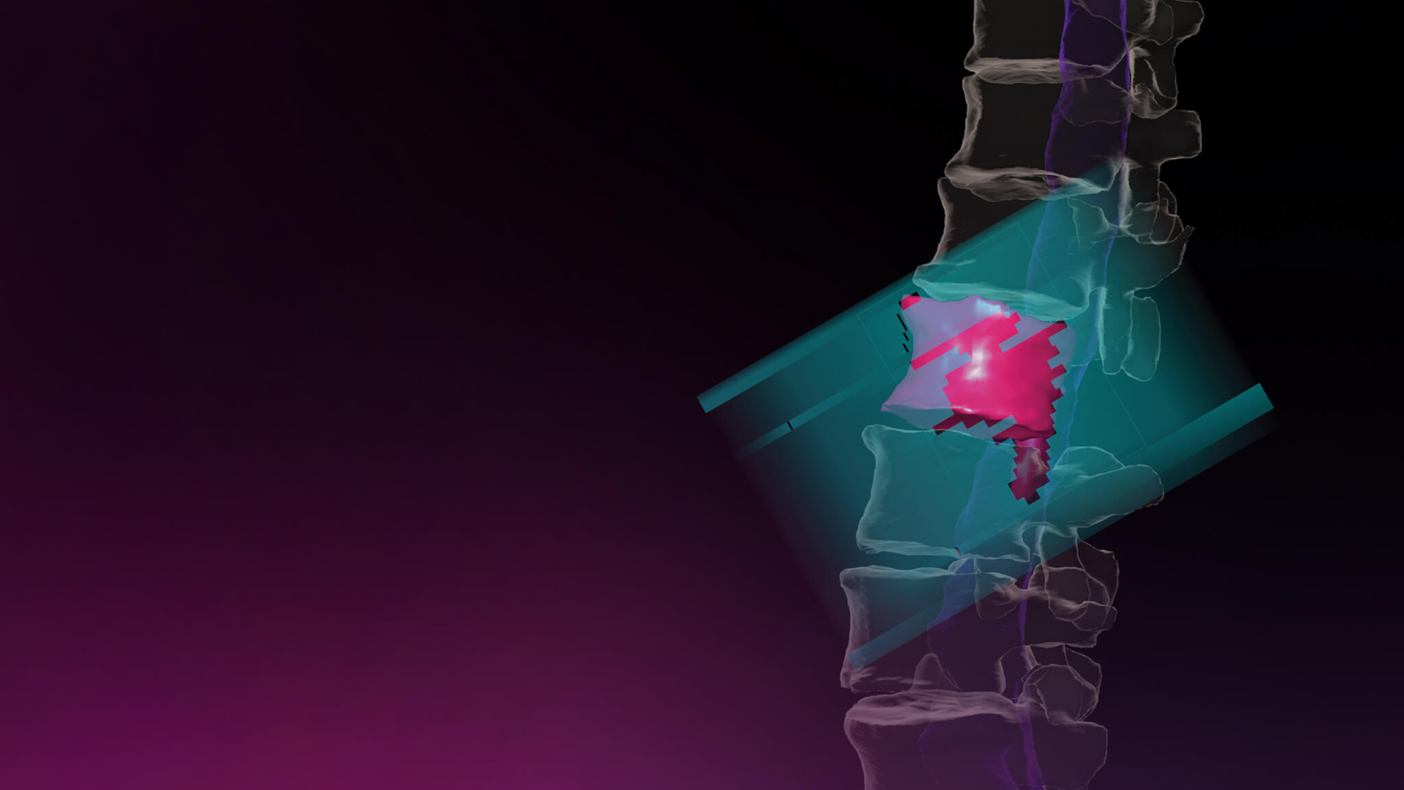 Elements Spine SRS: Spine Metastases Planning | Brainlab